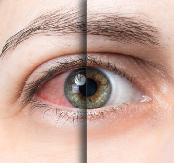 Comparison showing an irritated dry eye